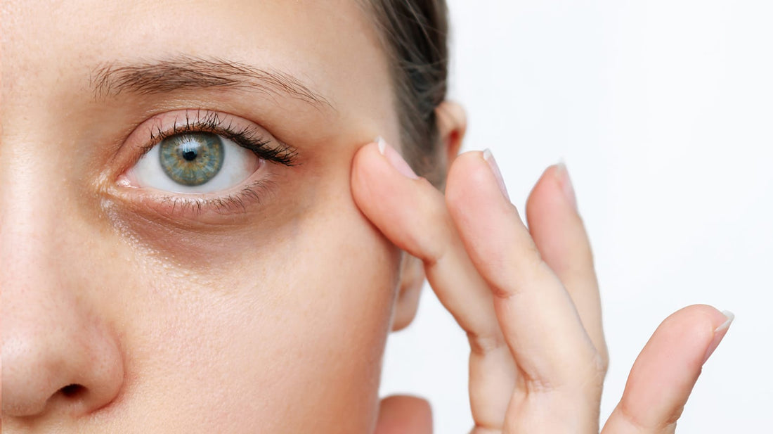 Woman with under eye circles