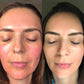 CO2Lift® Carboxy Gel Treatment - Before & After