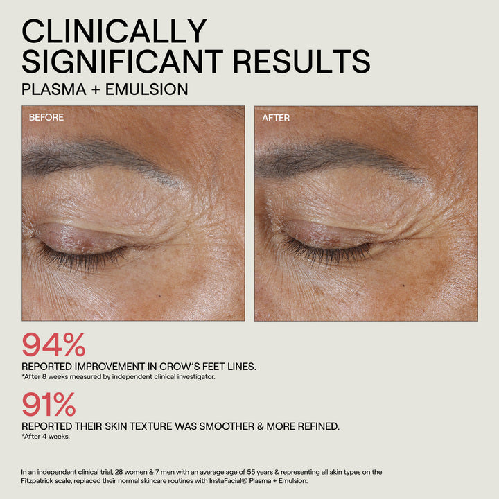 Before and after comparison of eye area skin treatment with clinically significant results.