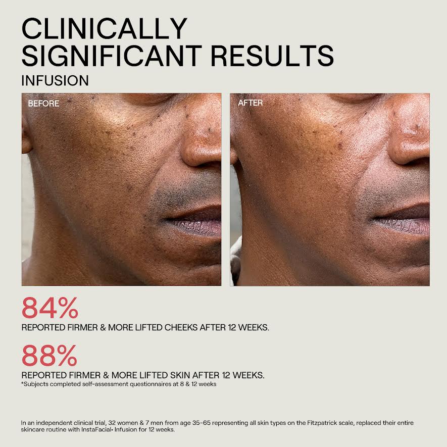 Before and after comparison of facial skin texture with text indicating clinically significant results from an infusion treatment.