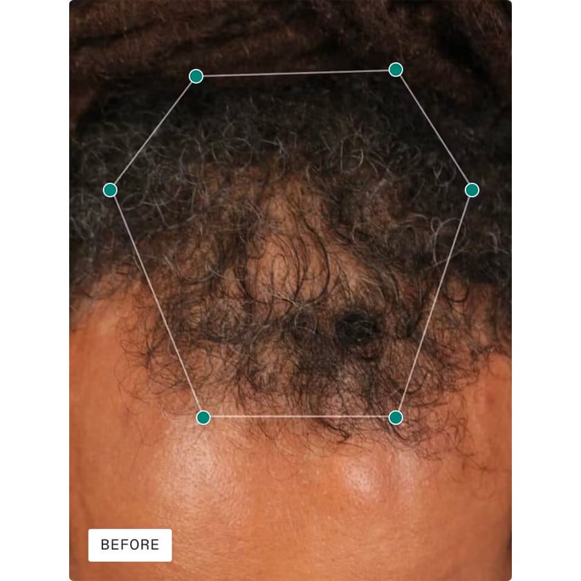 Nutrafol Men - Hair Growth Pack - Before