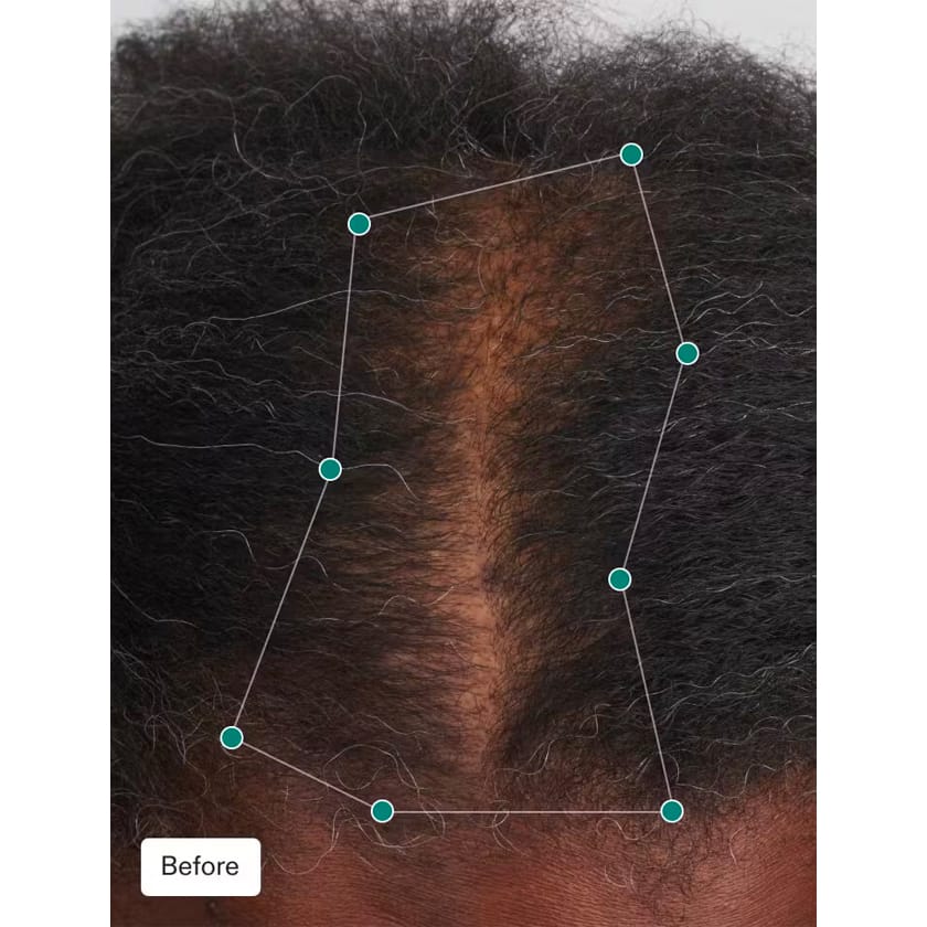 Nutrafol Women's Balance Hair Growth Pack - After